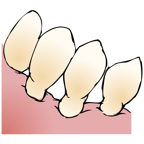 すり減っている歯
