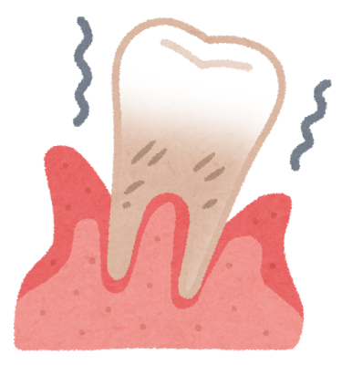 歯周病（歯槽膿漏）イメージ