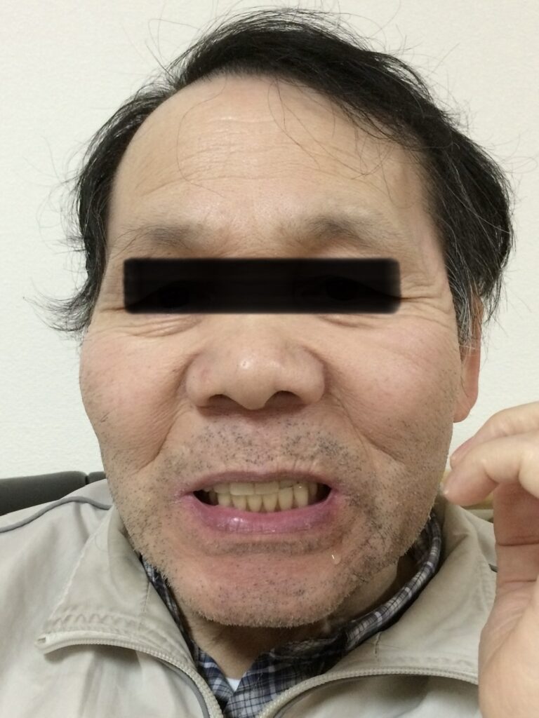 口の中の筋肉の動きを診てもらっている男性