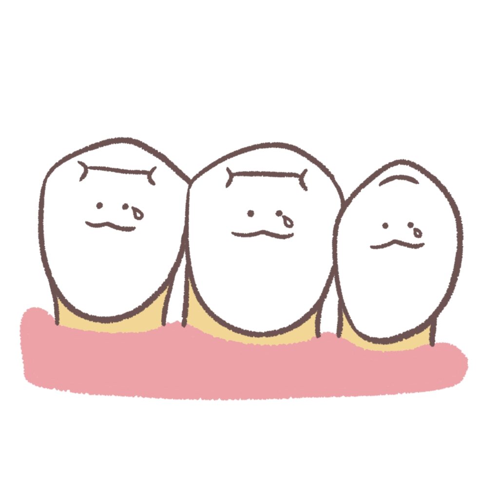 歯周病になった歯茎