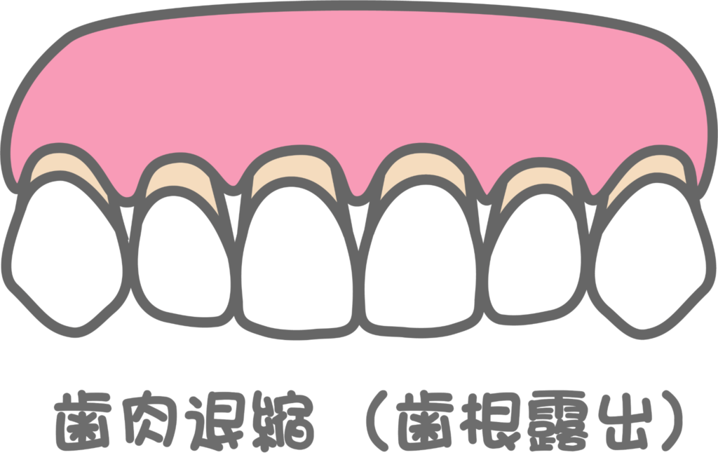 歯肉退縮