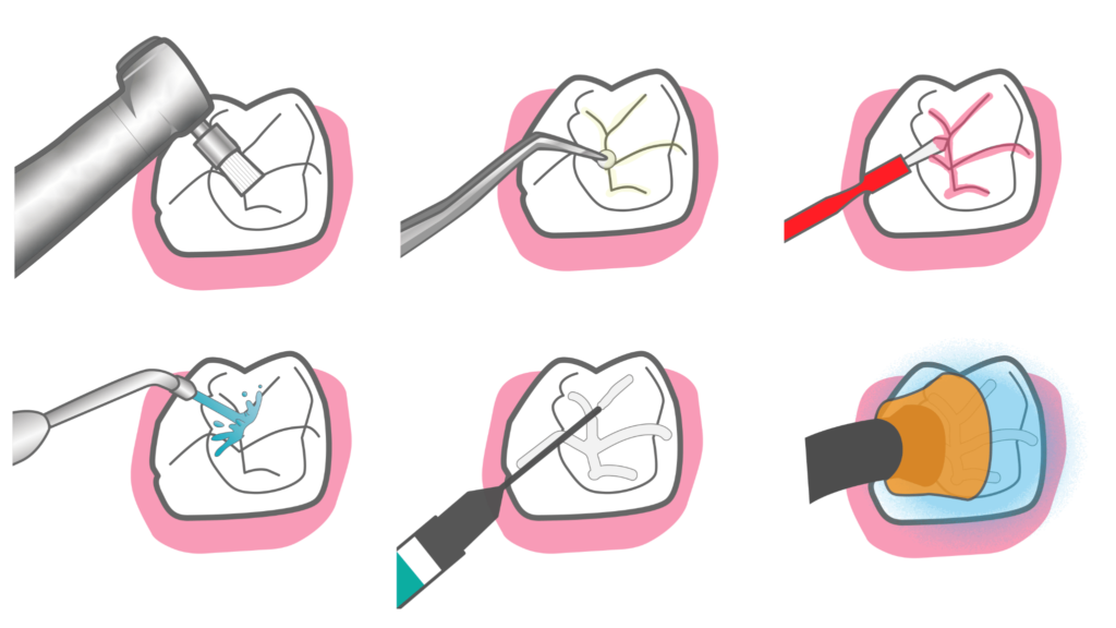 レジンによるコーティング