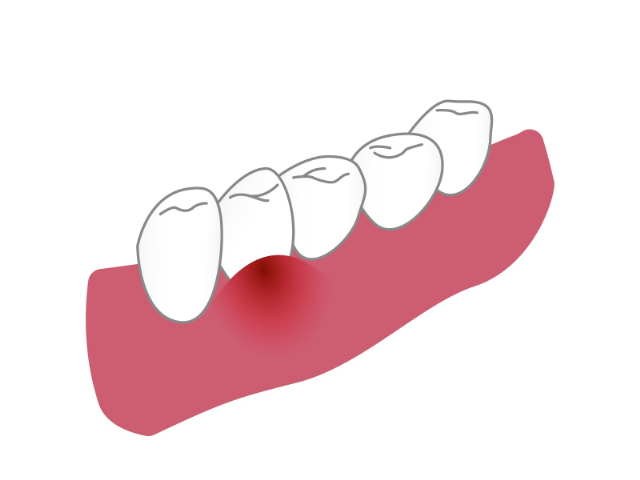 腫れた歯茎