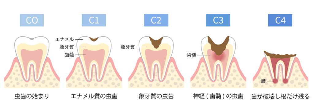 放置した虫歯の進行