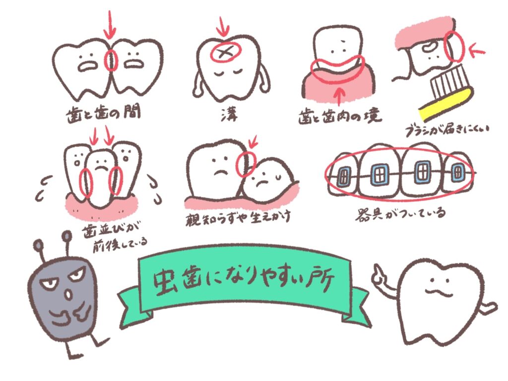 虫歯になりやすい場所